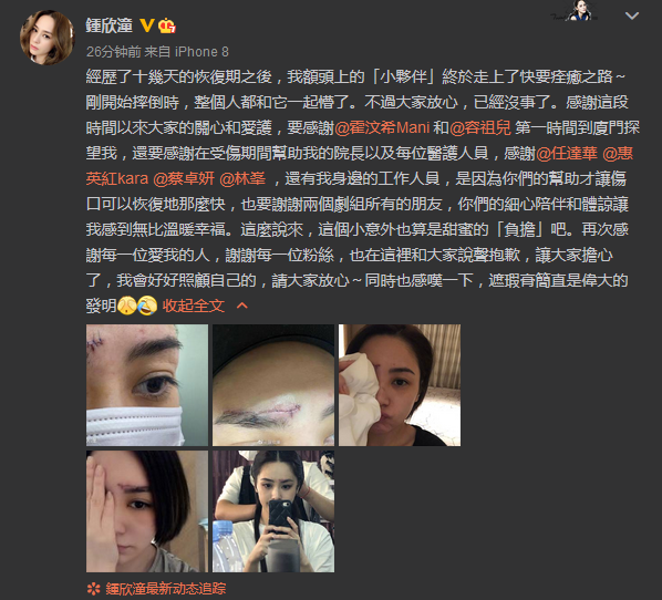 阿娇晒伤口恢复照，形容意外为甜蜜的“负担”