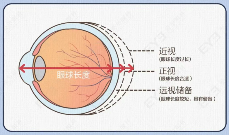 什么是软式内镜镜离焦软镜：谁适用？效果如何？注意事项全解析_https://www.jmylbn.com_新闻资讯_第3张